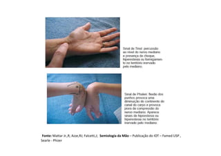 Fonte: Mattar Jr.,R; Azze,RJ; Falcetti,J; Semiologia da Mão – Publicação do IOT – Famed USP ,
Searle - Phizer
 