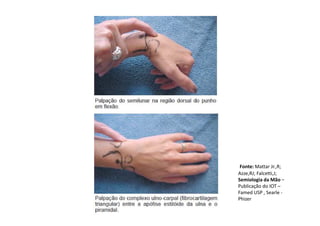 Fonte: Mattar Jr.,R;
Azze,RJ; Falcetti,J;
Semiologia da Mão –
Publicação do IOT –
Famed USP , Searle -
Phizer
 