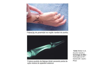 Fonte: Mattar Jr.,R;
Azze,RJ; Falcetti,J;
Semiologia da Mão –
Publicação do IOT –
Famed USP , Searle -
Phizer
 