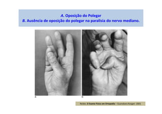 A. Oposição do Polegar
B. Ausência de oposição do polegar na paralisia do nervo mediano.
Reider, O Exame Físico em Ortopedia – Guanabara Koogan -2001
 