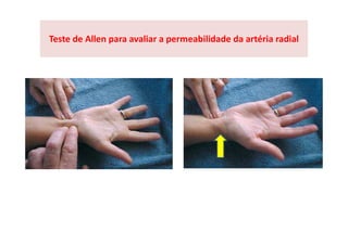 Teste de Allen para avaliar a permeabilidade da artéria radial
 