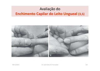 09/12/2015 Dr. José Heitor M. Fernandes 134
Avaliação do
Enchimento Capilar do Leito Ungueal (3,5)
 