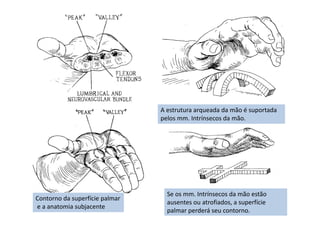Contorno da superfície palmar
e a anatomia subjacente
A estrutura arqueada da mão é suportada
pelos mm. Intrínsecos da mão.
Se os mm. Intrínsecos da mão estão
ausentes ou atrofiados, a superfície
palmar perderá seu contorno.
 