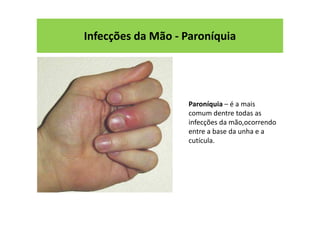 Infecções da Mão - Paroníquia
Paroníquia – é a mais
comum dentre todas as
infecções da mão,ocorrendo
entre a base da unha e a
cutícula.
 