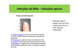 • Infecções apicais
podem ocorrer entre
a ponta da unha e o
leiro ungueal
subjacente.
Infecções da Mão – Infecções apicais
1- Lâmina ungueal: o que se convenciona chamar
de unha; porção rígida e translúcida, composta de
queratina.
2- Paroníquia: a dobra de pele nos lados da unha.
3- Lúnula: a parte branca convexa do leito da unha.
4- Eponíquio: a região entre a finalização da pele do
dedo na face superior da unha e a porção proximal
da unha.
Partes da Unha Humana
 