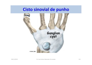 09/12/2015 Dr. José Heitor Machado Fernandes 151
Cisto sinovial de punho
 