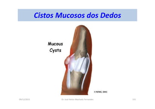 09/12/2015 Dr. José Heitor Machado Fernandes 155
Cistos Mucosos dos Dedos
 