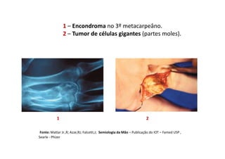 1 – Encondroma no 3º metacarpeâno.
2 – Tumor de células gigantes (partes moles).
Fonte: Mattar Jr.,R; Azze,RJ; Falcetti,J; Semiologia da Mão – Publicação do IOT – Famed USP ,
Searle - Phizer
1 2
 