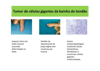Tumor de células gigantes da bainha do tendão
Aspecto clínico da
lesão tumoral
causando
deformidade no
dedo.
Detalhe do
abaulamento da
polpa digital com
crostícula por
trauma.
Exame
anatomopatológico
revelando células
histiocitárias,
fibroblastos e
numerosas células
gigantes
multinucleadas.
 