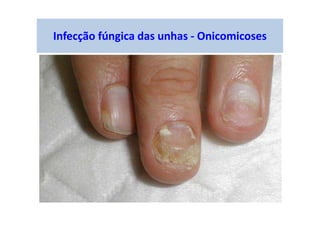 Infecção fúngica das unhas - Onicomicoses
 