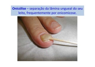 Onicólise – separação da lâmina ungueal do seu
leito, frequentemente por onicomicose.
 
