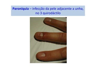 Paroníquia – infecção da pele adjacente a unha,
no 3 quirodáctilo
 