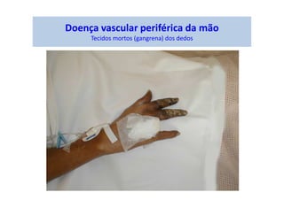 Doença vascular periférica da mão
Tecidos mortos (gangrena) dos dedos
 