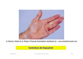 09/12/2015 Dr. José Heitor M. Fernandes 169
Contratura de Dupuytren
 