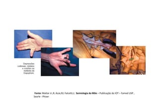 Fonte: Mattar Jr.,R; Azze,RJ; Falcetti,J; Semiologia da Mão – Publicação do IOT – Famed USP ,
Searle - Phizer
 