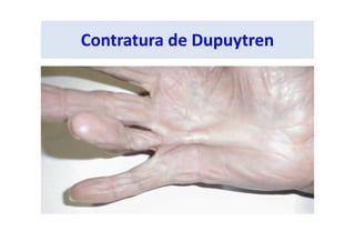 Contratura de Dupuytren
 