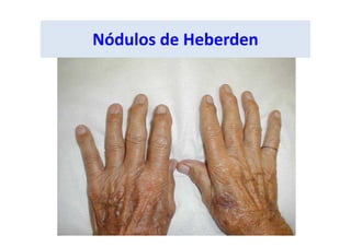 Nódulos de Heberden
 