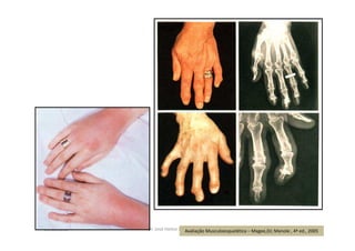 09/12/2015 Dr. José Heitor M. Fernandes 176Avaliação Musculoesquelética – Magee,DJ; Manole , 4ª ed., 2005
 