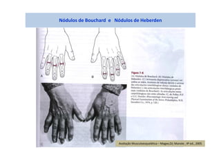 Nódulos de Bouchard e Nódulos de Heberden
Avaliação Musculoesquelética – Magee,DJ; Manole , 4ª ed., 2005
 