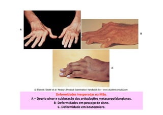 Deformidades inesperadas na Mão.
A – Desvio ulnar e subluxação das articulações metacarpofalangianas.
B- Deformidades em pescoço de cisne.
C- Deformidade em boutonniere.
 