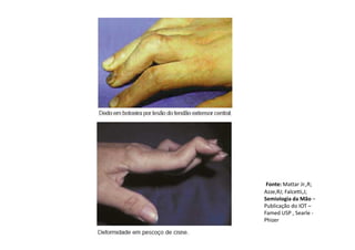 Fonte: Mattar Jr.,R;
Azze,RJ; Falcetti,J;
Semiologia da Mão –
Publicação do IOT –
Famed USP , Searle -
Phizer
 