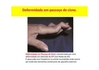 Deformidade em pescoço de cisne.
Deformidade em Pescoço de Cisne: caracterizada por uma
deformidade em extensão da IFP com flexão do IFD.
É observada com freqüência na artrite reumatóide onde ocorre
por lesão dos elementos contensores do aparelho extensor.
 