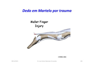 09/12/2015 Dr. José Heitor Machado Fernandes 196
Dedo em Martelo por trauma
 