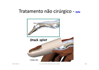 09/12/2015 Dr. José Heitor Machado Fernandes 198
Tratamento não cirúrgico - tala
 