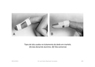 09/12/2015 Dr. José Heitor Machado Fernandes 199
Tipos de tala usadas no tratamento do dedo em martelo.
(A) tala dorsal de alumínio. (B) Tala comercial.
 
