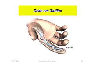 09/12/2015 Dr. José Heitor M. Fernandes 203
Dedo em Gatilho
 