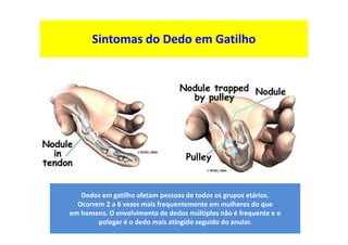 Dr. José Heitor Machado Fernandes
Sintomas do Dedo em Gatilho
Dedos em gatilho afetam pessoas de todos os grupos etários.
Ocorrem 2 a 6 vezes mais frequentemente em mulheres do que
em homens. O envolvimento de dedos múltiplos não é frequente e o
polegar é o dedo mais atingido seguido do anular.
 