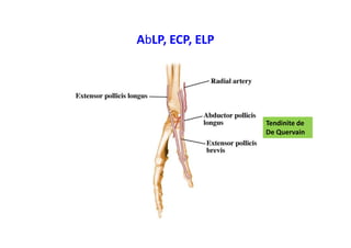 AbLP, ECP, ELP
Tendinite de
De Quervain
 