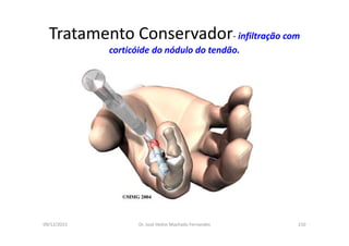 09/12/2015 Dr. José Heitor Machado Fernandes 210
Tratamento Conservador- infiltração com
corticóide do nódulo do tendão.
 