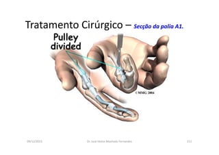 09/12/2015 Dr. José Heitor Machado Fernandes 211
Tratamento Cirúrgico – Secção da polia A1.
 