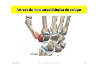 09/12/2015 Dr. José Heitor Machado Fernandes 213
Artrose da metacarpofalângica do polegar
 