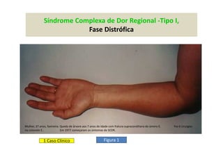 Síndrome Complexa de Dor Regional -Tipo I,
Fase Distrófica
Figura 1
Mulher, 37 anos, faxineira. Queda de árvore aos 7 anos de idade com fratura supracondiliana do úmero E. Fez 6 cirurgias
no cotovelo E.. Em 1977 começaram os sintomas de SCDR.
1 Caso Clínico
 