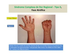 Síndrome Complexa de Dor Regional - Tipo II,
Fase Atrófica
Figura 1
Mulher 38 anos, auxiliar de cozinha. Queixas de dor nos tendões flexores do punho D. Fez
2 infiltrações com glicocorticóide + tala gessada. Mão inchou. Fez ENMG em FEV/ 1999 =
STC Evoluiu com Mão em Garra.
2 Caso Clínico
 