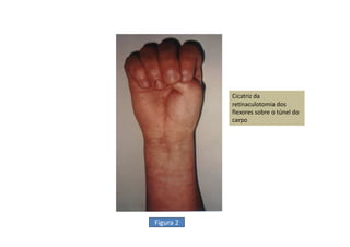 Figura 2
Cicatriz da
retinaculotomia dos
flexores sobre o túnel do
carpo
 