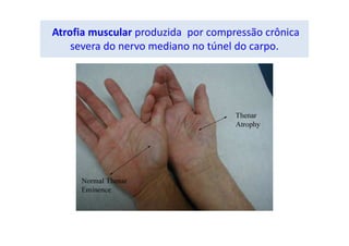 Atrofia muscular produzida por compressão crônica
severa do nervo mediano no túnel do carpo.
 