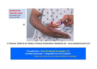 Procedimento = Teste da abdução do polegar (3,5)
Condição Detectada = integridade do nervo mediano
(único nervo que inerva o músculo abdutor do polegar)
Síndrome do
Túnel do carpo
(neuropatia mais
comum do MS)
 