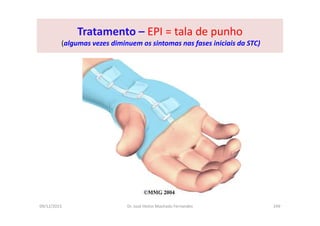 09/12/2015 Dr. José Heitor Machado Fernandes 249
Tratamento – EPI = tala de punho
(algumas vezes diminuem os sintomas nas fases iniciais da STC)
 
