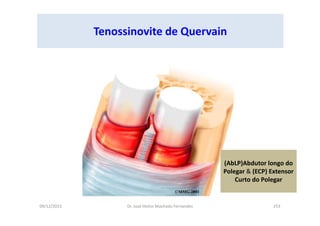 09/12/2015 Dr. José Heitor Machado Fernandes 253
Tenossinovite de Quervain
(AbLP)Abdutor longo do
Polegar & (ECP) Extensor
Curto do Polegar
 