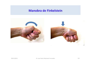 09/12/2015 Dr. José Heitor Machado Fernandes 257
Manobra de Finkelstein
 