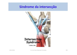 09/12/2015 Dr. José Heitor Machado Fernandes 258
Síndrome da intersecção
 