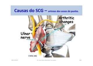 09/12/2015 Dr. José Heitor Machado Fernandes 264
Causas do SCG – artrose dos ossos do punho.
 