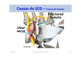 09/12/2015 Dr. José Heitor Machado Fernandes 265
Causas do SCG – Fratura do hamato
 