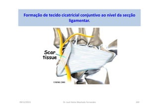 09/12/2015 Dr. José Heitor Machado Fernandes 269
Formação de tecido cicatricial conjuntivo ao nível da secção
ligamentar.
 