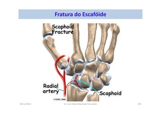 09/12/2015 Dr. José Heitor Machado Fernandes 278
Fratura do Escafóide
 