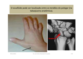 09/12/2015 Dr. José Heitor Machado Fernandes 279
O escafóide pode ser localizado entre os tendões do polegar (na
tabaqiueira anatômica).
 
