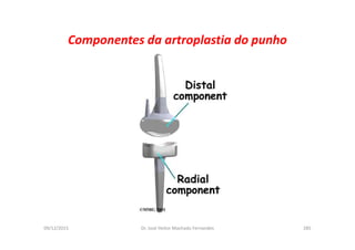 09/12/2015 Dr. José Heitor Machado Fernandes 285
Componentes da artroplastia do punho
 